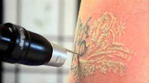 DETATOUAGE AU LASER