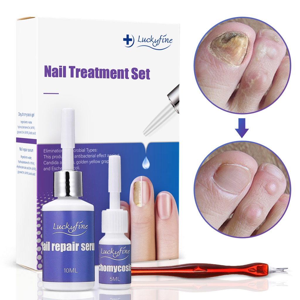 Traitement des Ongles