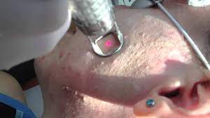 Dermabrasion Corps