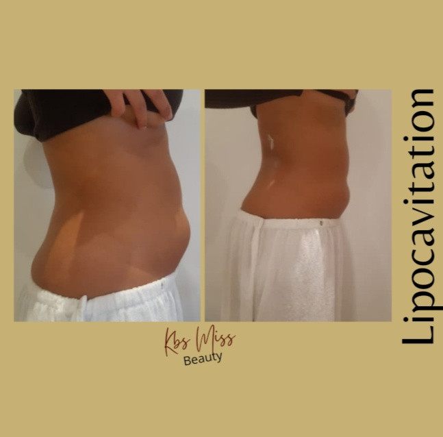 Lipocavitation (Ventre-Hanches) 10 Séances