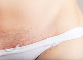 Epilation Maillot à la Cire