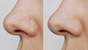 TRAITEMENT PORE DILATÉ AU LASER