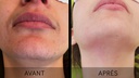L’ÉPILATION AU LASER DIODE (POILS CORPS ET VISAGE