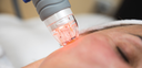 RF Microneedling (Package de 4 séances)