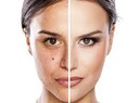 BB Glow + Hydra-Facial