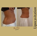 Lipocavitation (Ventre-Hanches-Bras)