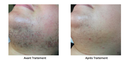 Epilation Cou au Laser