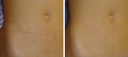 Epilation Ventre au Laser