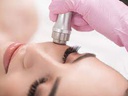 Dermabrasion + Méso